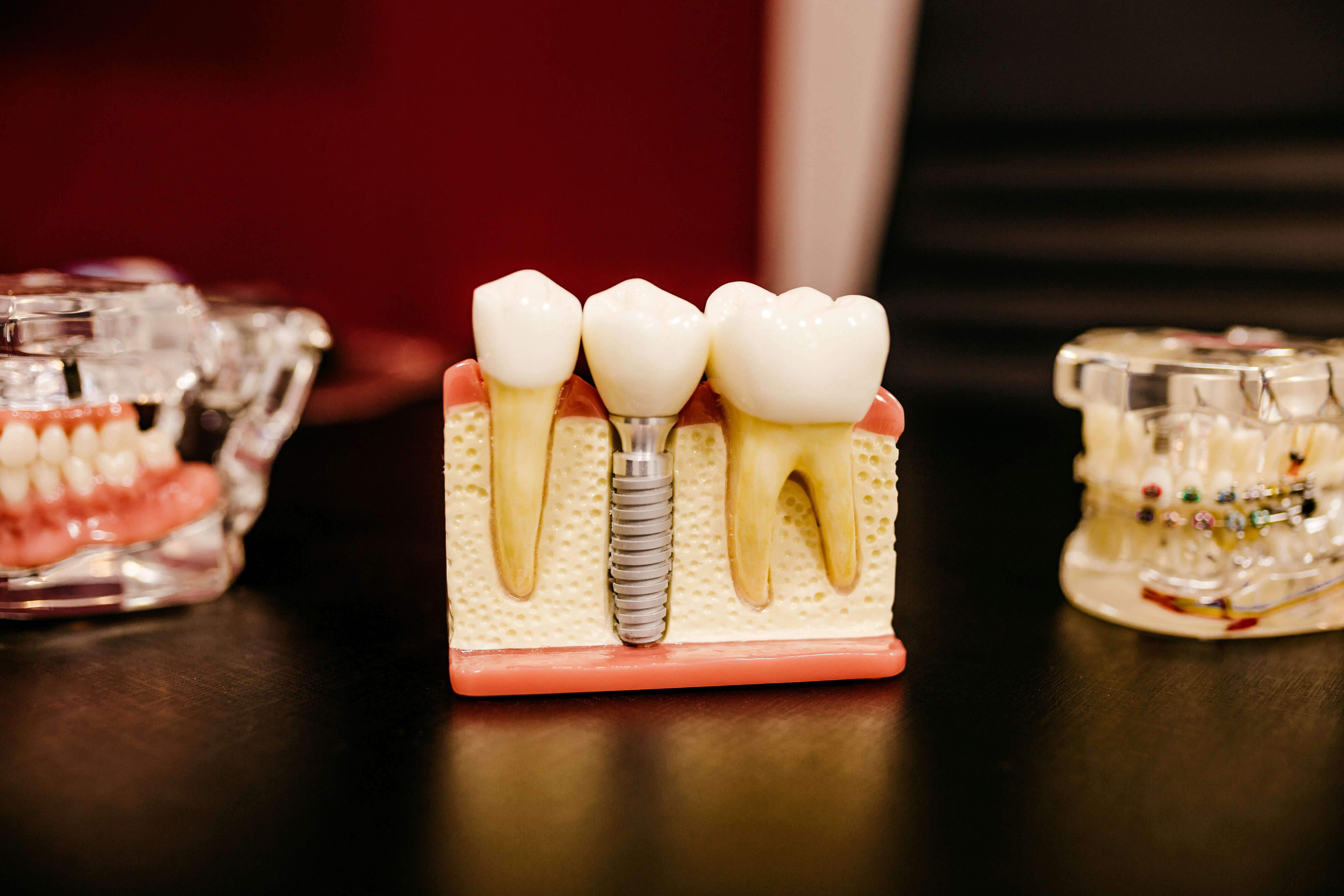 Implantes 3D
